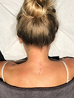 Acupuncture at The Bellissima Clinic